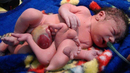 Iraq-birth_defects-2