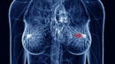 Breast_cancer