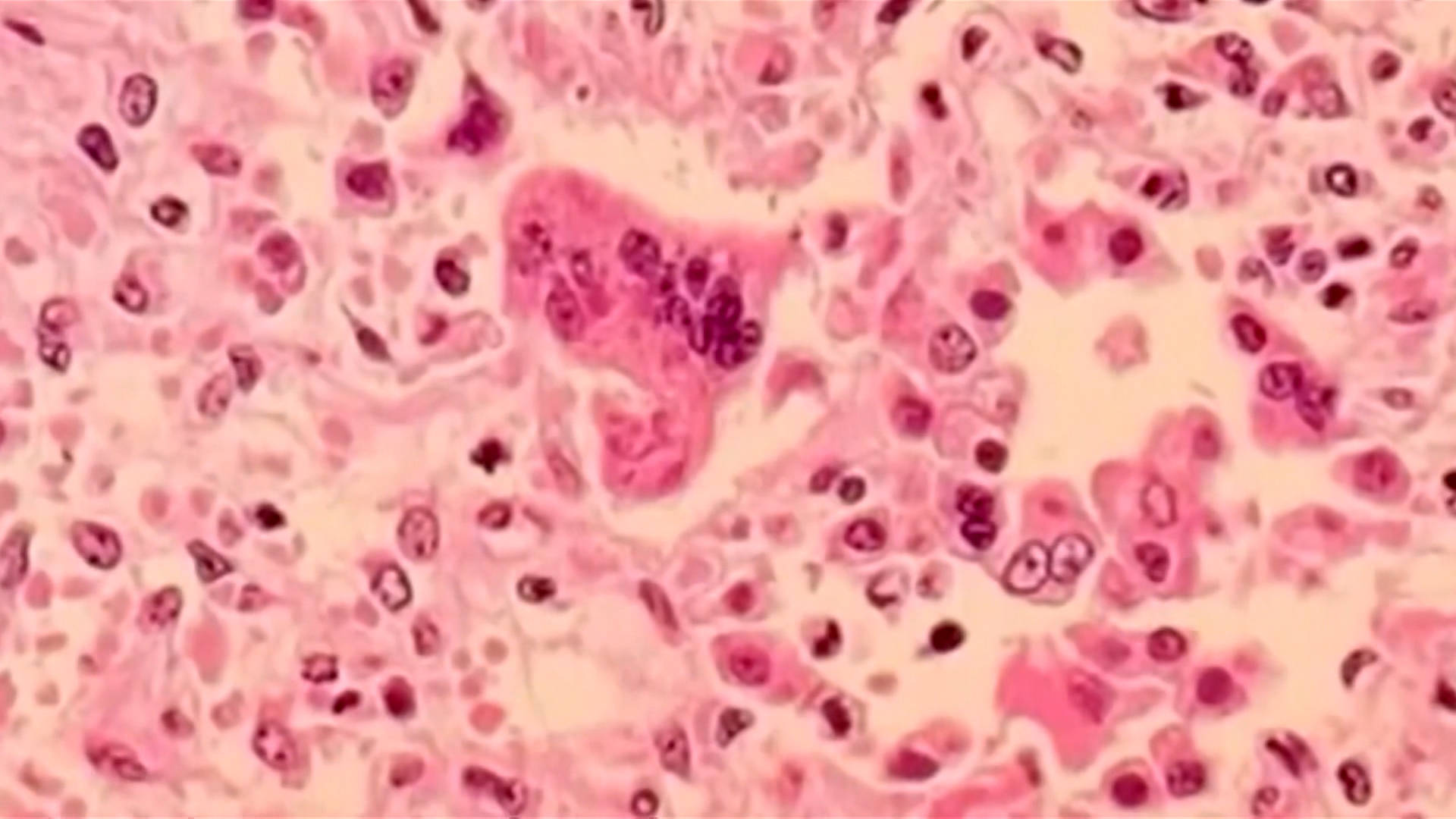 South Carolina Measles Outbreak Reaches Nearly 800 Cases